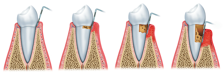 periodontal-disease-progression