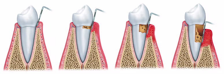 Periodontal gum disease progression